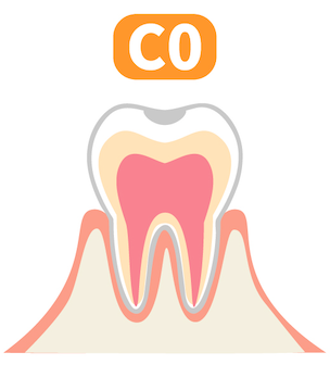 C0(初期虫歯)